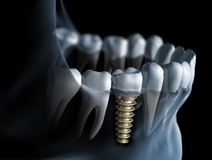 Single tooth implants